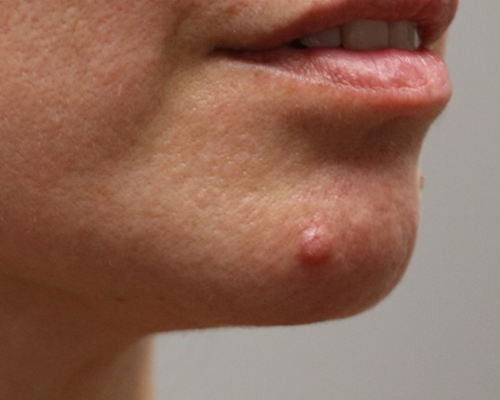 patient 1 before lesion removal.PNG