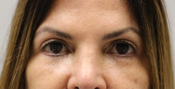 patient 3 after lid retraction repair.PNG