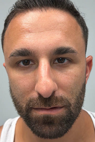 1_0000_before chin and jawline filler – front