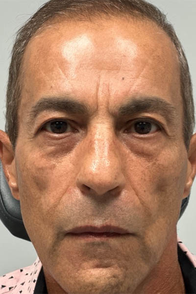 1_0000_before glabella filler