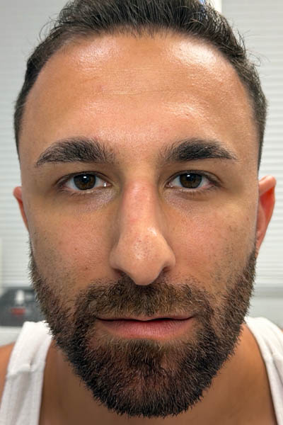 1_0001_after chin and jawline filler – front