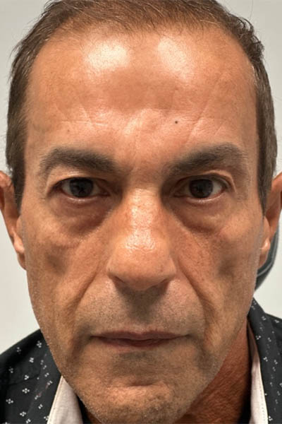 1_0001_after glabella filler