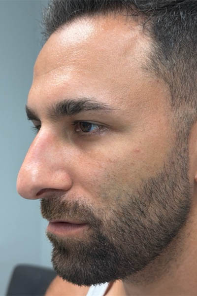 1_0002_before chin and jawline filler – side