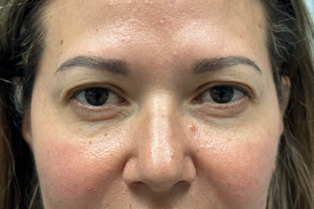1_0002_before upper bleph with subbrow filler- front.png