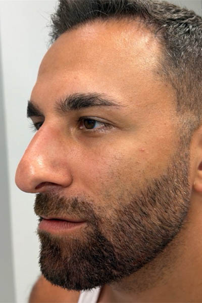 1_0003_after chin and jawline filler – side
