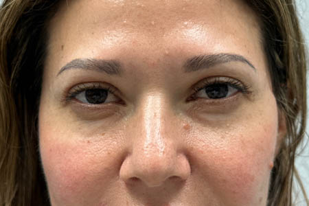 1_0003_after upper bleph with subbrow filler- front.png
