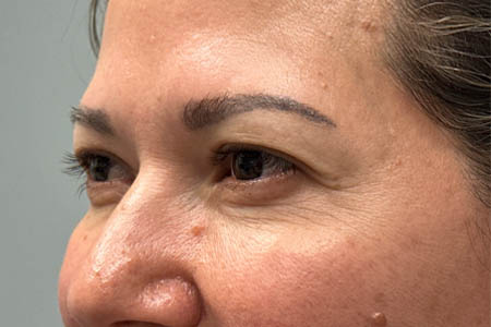 1_0004_before upper bleph with subbrow filler- side.png