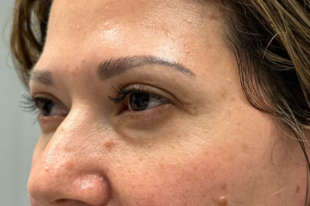 1_0005_after upper bleph with subbrow filler- side.png