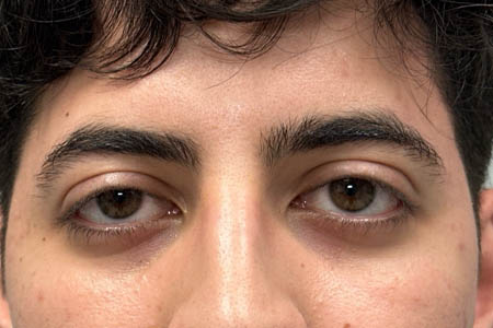 1_0006_pt 9 before ptosis repair and subbrow filler – front.png