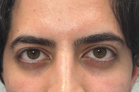 1_0007_pt 9 after ptosis repair and subbrow filler – front.png