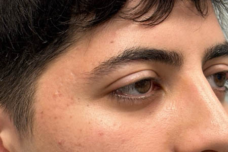 1_0008_pt 9 before ptosis repair and subbrow filler – side.png