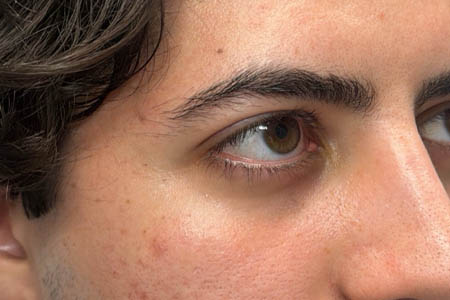 1_0009_pt 9 after ptosis repair and subbrow filler – side.png