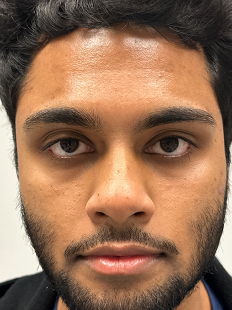 after ptosis repair and subbrow filler.png