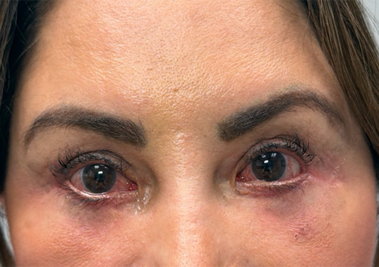 after scar revision with 5FU injection