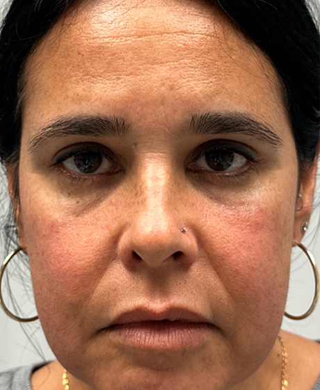 after upper and lower bleph with fat grafting and temp brow lift.png