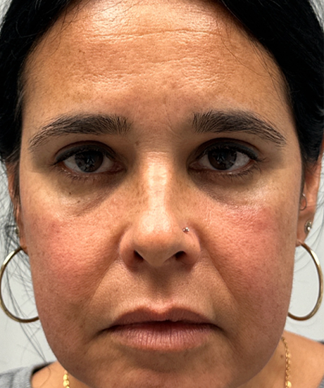 after upper and lower bleph with fat grafting and temp brow lift.png