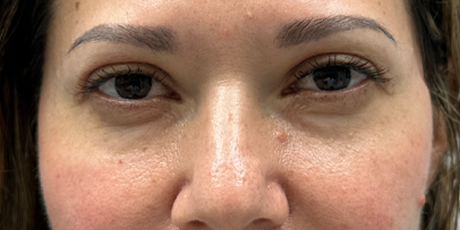 after upper bleph with subbrow filler- front.png