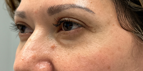 after upper bleph with subbrow filler- side.png