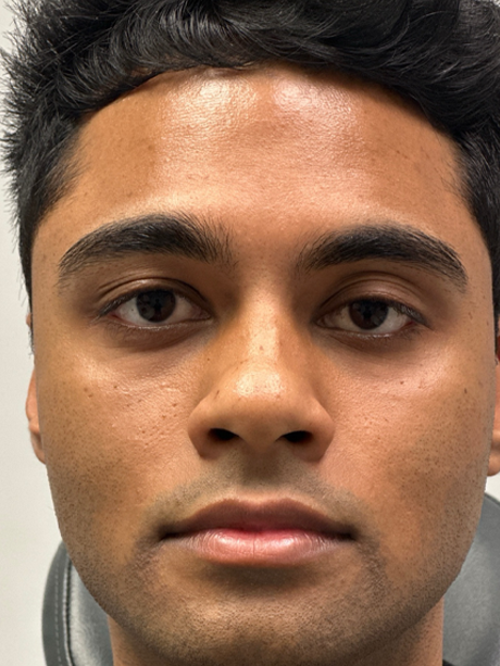 before ptosis repair and subbrow filler.png