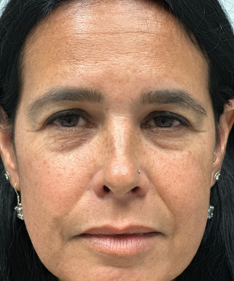 before upper and lower bleph with fat grafting and temp brow lift.png