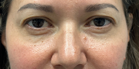 before upper bleph with subbrow filler- front.png