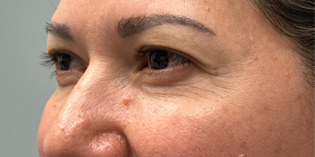 before upper bleph with subbrow filler- side.png