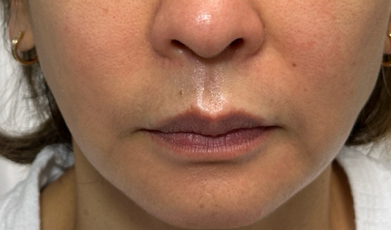 after PRF injections around the mouth and nasolabial folds.png