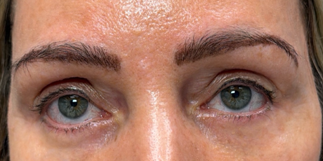 after facial fat transfer to brows.png