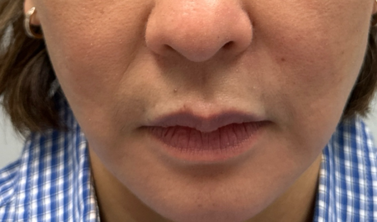 before PRF injections around the mouth and nasolabial folds.png