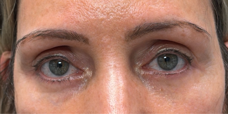 before facial fat transfer to brows.png