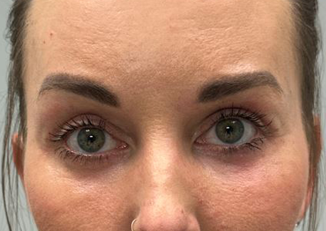 PT 45 after — EYES ONLY– upper and lower bleph with facial fat grafting, peri-orbital CO2 laser, temporal brow lift and pre surgical hyaluronidase.JPG