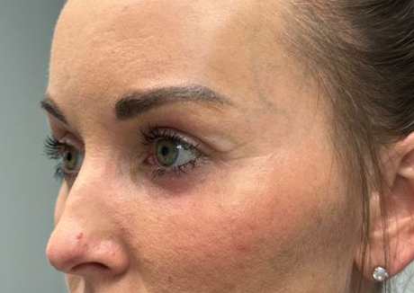PT 45 after side– EYES ONLY– upper and lower bleph with facial fat grafting, peri-orbital CO2 laser, temporal brow lift and pre surgical hyaluronidase.JPG