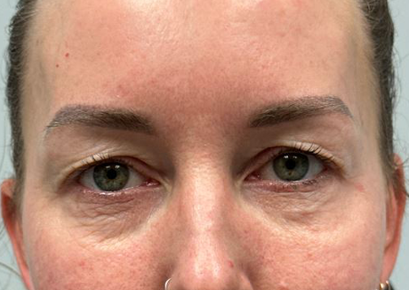 PT 45 before — EYES ONLY– upper and lower bleph with facial fat grafting, peri-orbital CO2 laser, temporal brow lift and pre surgical hyaluronidase.JPG