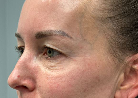 PT 45 before side– EYES ONLY– upper and lower bleph with facial fat grafting, peri-orbital CO2 laser, temporal brow lift and pre surgical hyaluronidase.JPG