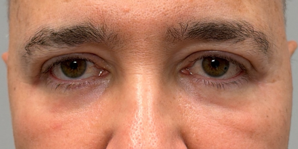 after lower bleph with facial fat grafting and peri-orbital CO2 laser.png