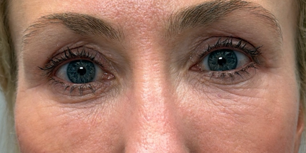 after quad bleph with peri-orbital CO2 laser and facial fat grafting.png
