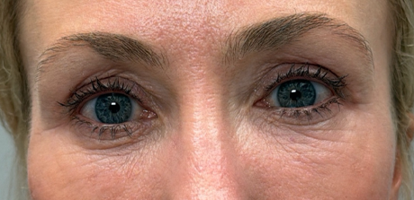 after quad bleph with peri-orbital CO2 laser and facial fat grafting.png