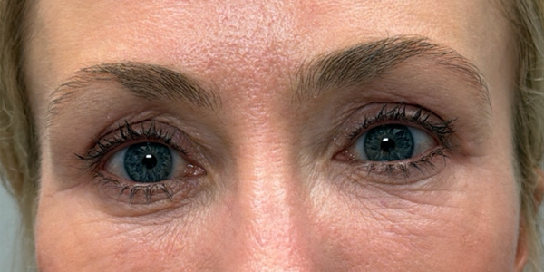 after quad bleph with peri-orbital CO2 laser and facial fat grafting.png