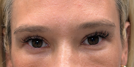 after upper bleph with fat to brows.png
