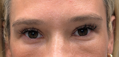 after upper bleph with fat to brows.png