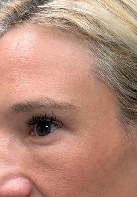 after upper bleph with fat to brows- side.png