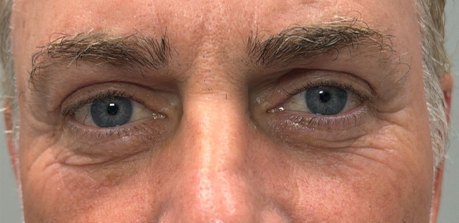 after upper bleph with subbrow filler and direct brow lift.png