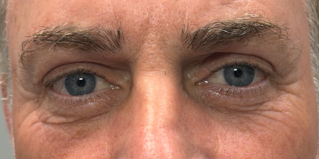 after upper bleph with subbrow filler and direct brow lift.png