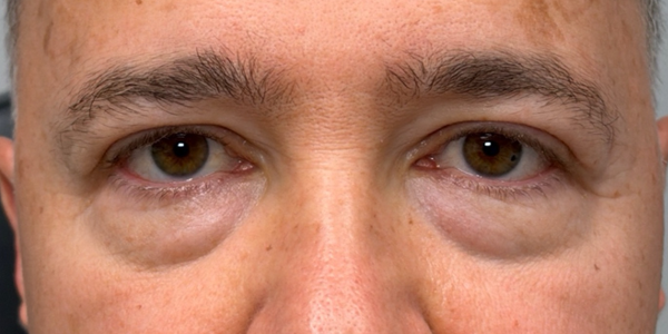 before lower bleph with facial fat grafting and peri-orbital CO2 laser.png