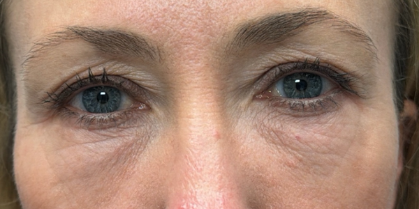 before quad bleph with peri-orbital CO2 laser and facial fat grafting.png