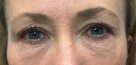 before quad bleph with peri-orbital CO2 laser and facial fat grafting.png