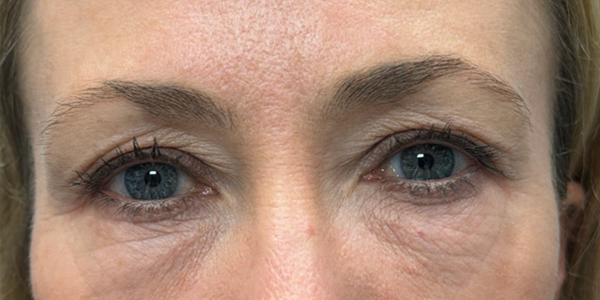 before quad bleph with peri-orbital CO2 laser and facial fat grafting.png