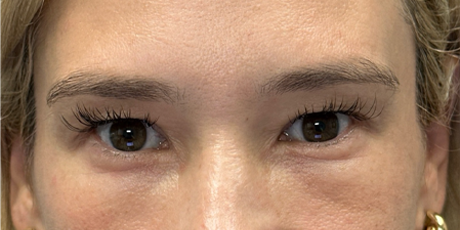 before upper bleph with fat to brows.png
