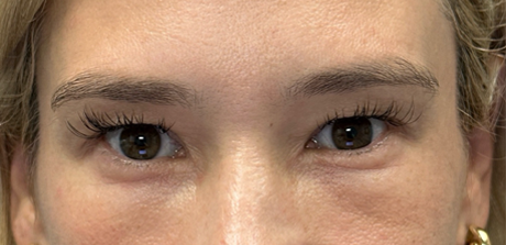 before upper bleph with fat to brows.png