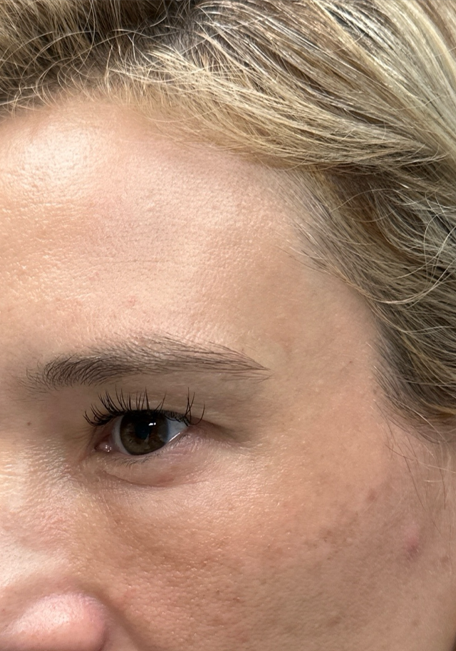 before upper bleph with fat to brows- side.png